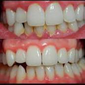Limpeza Dentaria