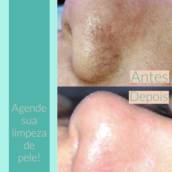 Limpeza de pele
