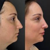 Perfiloplastia