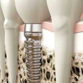 Implantes dentários em Bauru