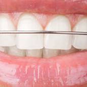 Aparelho Dental Móvel Contenção