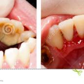 Limpeza Dental