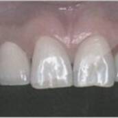 Implante Dentário