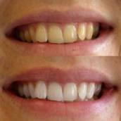 Clareamento Dental