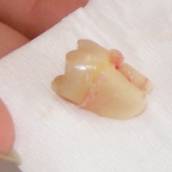 Remoção do Dente do Siso