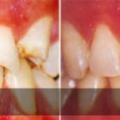 Aparelho nos Dentes