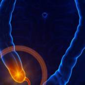 Apendicite – Saiba qual a função do apêndice em nosso corpo.