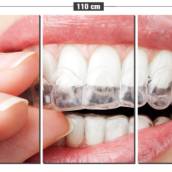 Clareamento Dental