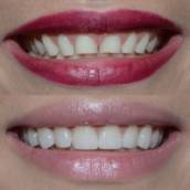 Lente de contato dentário em Avaré