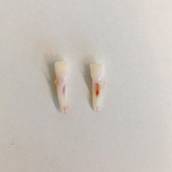 Remoção de dente de leite em Avaré
