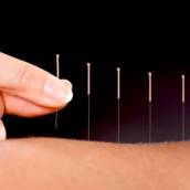 Acupuntura