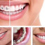 Aparelho Dentário