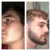 Minoxidil 5% 30 ml em Solução Capilar