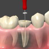 Endodontia (Tratamento de Canal)