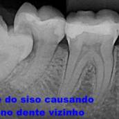 Cirurgia Implante
