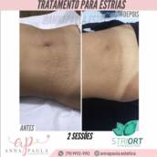 Tratamento para estrias - Striort