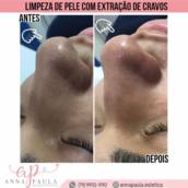 Limpeza de pele com extração de cravos