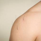 Acupuntura 