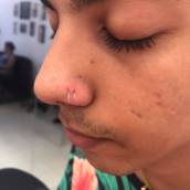 Perfuração aba Nasal
