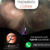 Tratamento Calvície 