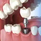 Implantes Dentários