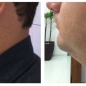 Criofrequência - Rosto em Avaré