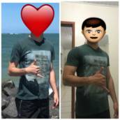 Hipertrofia