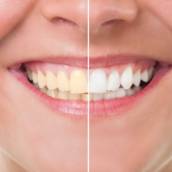Odontologia estética (clareamento, facetas e lentes de contato)