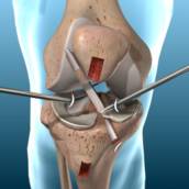 Reconstrução ligamentar do joelho por vídeo 