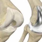 Artroplastia total de joelho (prótese total)