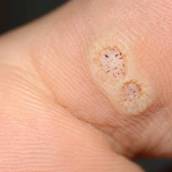 Verruga plantar