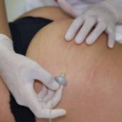 Tratamento para Estrias - Pele Suave e Uniforme no Centro Estético Anita Lopes