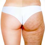 Tratamento para Celulite - Pele Lisa e Uniforme no Centro Estético Anita Lopes