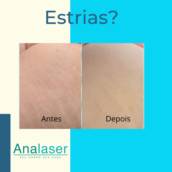Estrias? Nunca mais!