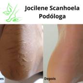 Antes e Depois  - Calos nos pés