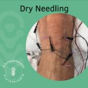 Dry Needling