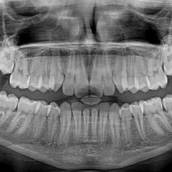 Levantamento Periapical (Boca toda)