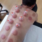 Ventosa Terapia 