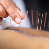 Acupuntura