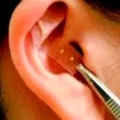Acupuntura auricular em Bauru