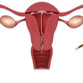 DIU - Dispositivo Intrauterino