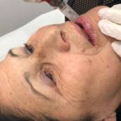 Rejuvenescimento Labial