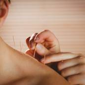 Acupuntura