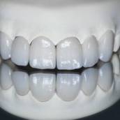 Facetas e Lentes: Sorriso Estético e Natural em Uberlândia/MG