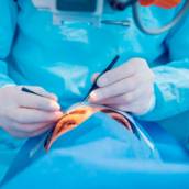 CIRURGIA DE PTERÍGIO COM AUTOTRANSPLANTE