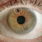 IRIDOTOMIA COM YAG LASER