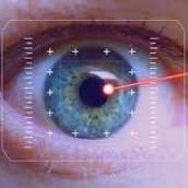 CAPSULOTOMIA COM YAG LASER