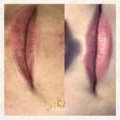 Revitalização labial