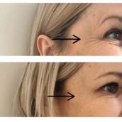 - Aplicação de Botox (Toxina Botulinica)