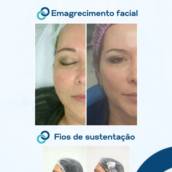 Emagrecimento Facial e Fios de Sustentação 